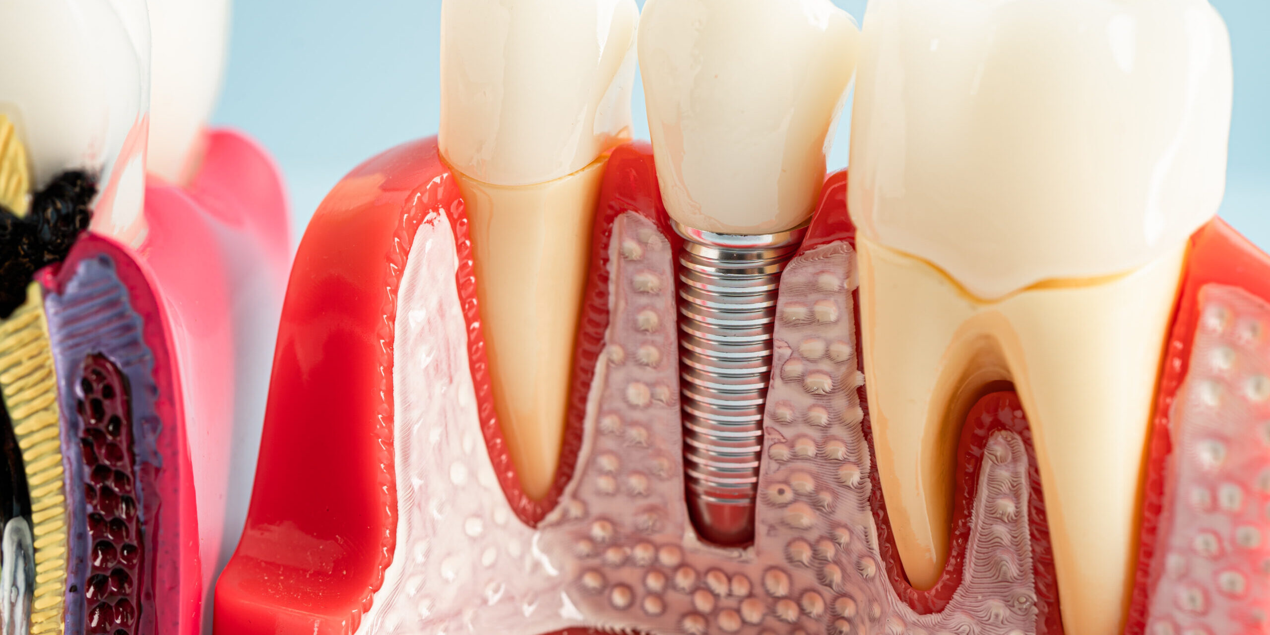 Dental implant, artificial tooth roots into jaw, root canal of d